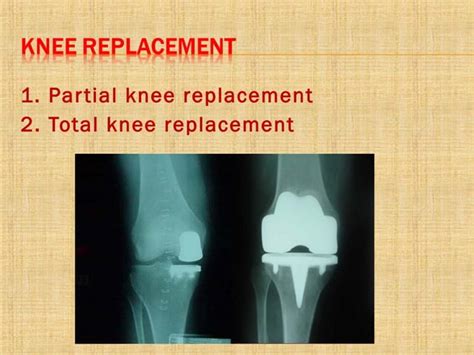 postoperative nursing care after total knee replacement ppt|BONES: A postoperative plan of care and education program for .